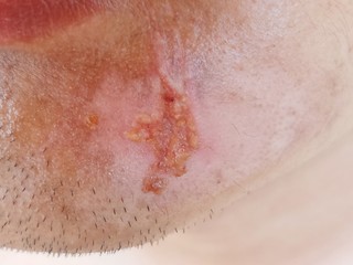 Lesion from accident on the face,Men have lesion on the chin.