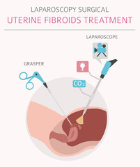 Uterine fibroids. Ginecological medical desease in women infographic