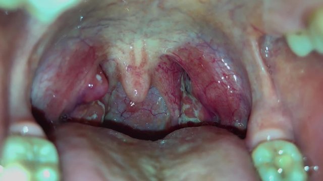 Angina, purulent tonsillitis, throat with pus on tonsils. The throat of a young girl, which is covered with white and black pus. 4k video.	