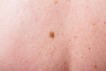 Fototapeta premium the doctor examines the birthmarks on the man's body