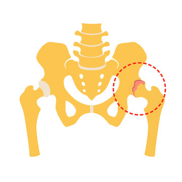 Fragment of the structure of the human skeleton. Pelvic girdle and hips. Coxarthrosis. Destruction of connective cartilaginous tissue. Silhouette. Sign. Vector. Flat design