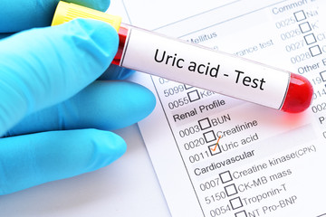 Blood sample tube with laboratory requisition form for uric acid test, gouty arthritis diagnosis