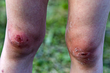 Fototapeta premium children's broken knees, blood from wounds