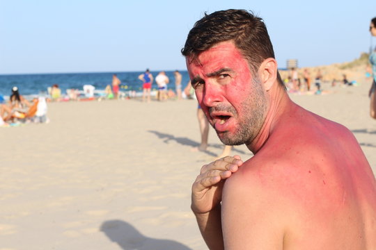 Man with lost of redness after suntanning 