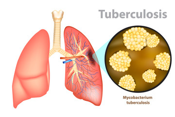 Tuberculosis is an infectious disease caused by the bacterium Mycobacterium tuberculosis.
