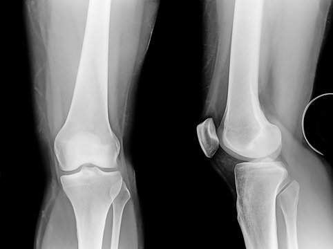 X-ray of the knee, lateral and posterior views.