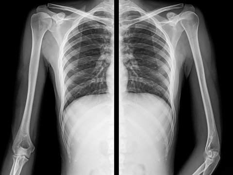 X-Ray Image of the human Chest with the arms, left and right side.