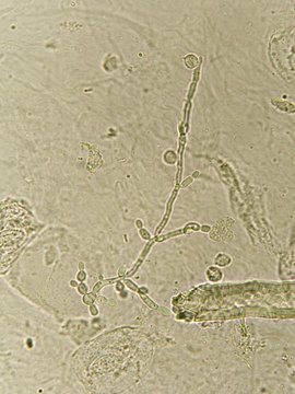 Pseudohyphae and budding yeast cells in patient urine (urinary tract infections), analyze by microscope
