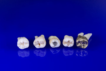 Naklejka premium der Weg der Karies von der Füllung bis zur Gusskrone