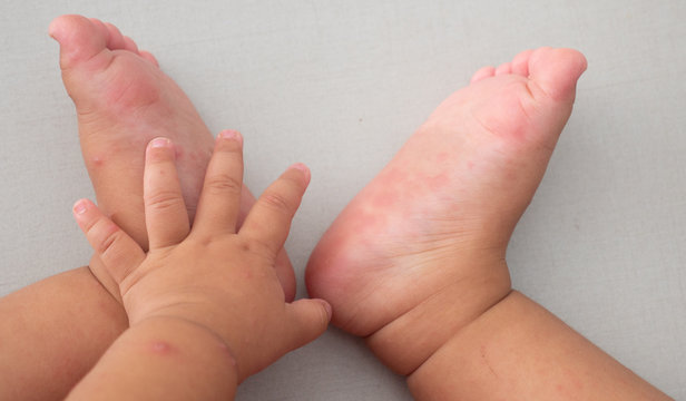 Hand, Foot And Mouth Disease Of Kid