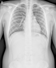 chest x-ray a boy 12 year old. show normal heart size and bony thorax Impression:Healthy chest.
