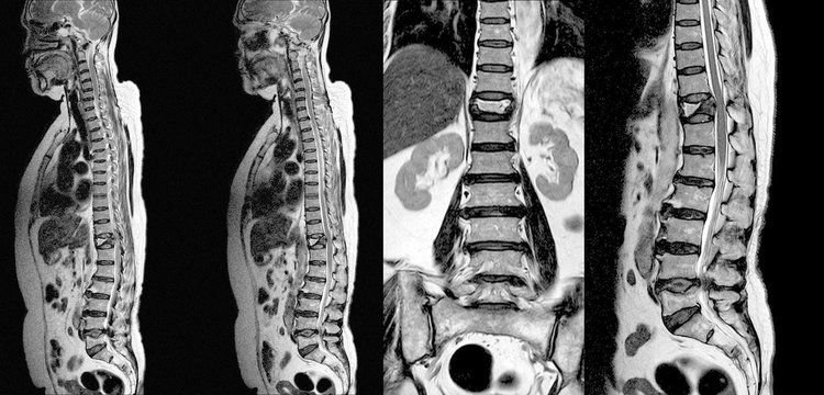 MRI THORACIC-LUMBAR Spine:Moderate pathological compression fracture of T12 level vertebral body.