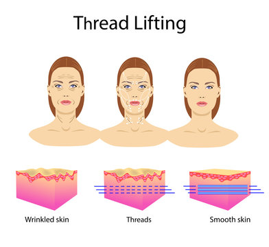 Thread lifting, vector illustration, face of a girl