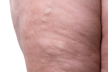 Varicose veins closeup, fat female legs