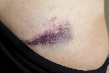 Macro shot of young woman with bruise, hematoma on pelvis