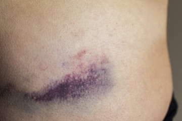 Macro shot of young woman with bruise, hematoma on pelvis
