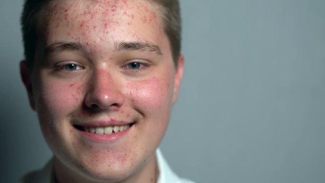 Portrait of happy young boy with problem skin, smiling and looking at camera in studia on background grey. 4K Close-up shot