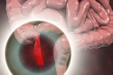 Foto op Canvas Acute appendicitis, 3D illustration showing inflammed appendix on the cecum © Dr_Microbe