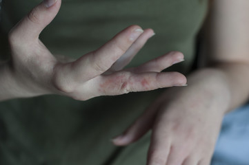 Pain in hands. Sore at woman hand. Scabies in macro, itchy fingers