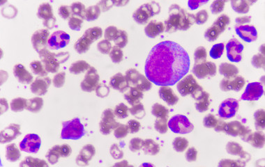 Immature blood cells in leukemia.