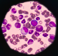 Immature blood cells in leukemia.