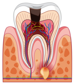 A Human Tooth Decay and Cavity
