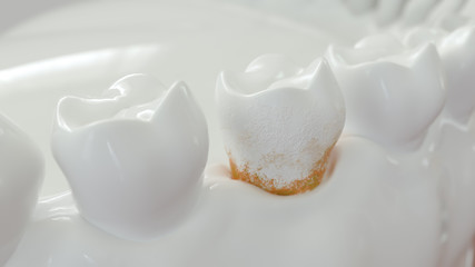 strong plaque on a molar tooth - 3D Rendering