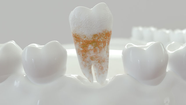 strong plaque on a molar tooth - 3D Rendering