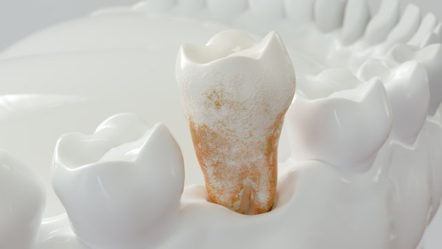 strong plaque on a molar tooth - 3D Rendering