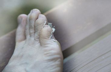 Closeup of eczema on male toes with skin peeling