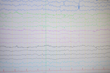 Computer monitor showing electrical activity of abnormal brain,EEG of the pediatric patients with problems in the brain.