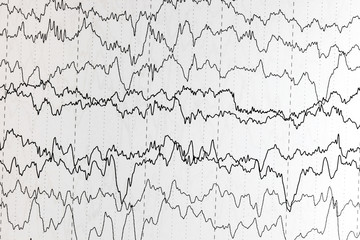 EEG of the pediatric patients, problems in the electrical activity of the brain.Abnormal EEG.