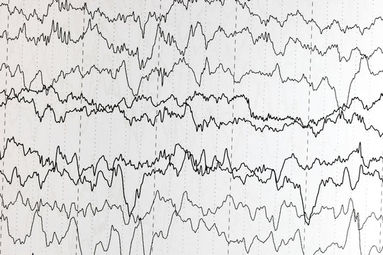 EEG of the pediatric patients, problems in the electrical activity of the brain.Abnormal EEG.