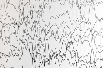 EEG of the pediatric patients, problems in the electrical activity of the brain.Abnormal EEG.
