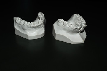 Molde da boca de um paciente criança para a colocação de um aparelho ortodôntico para realinhamento dental