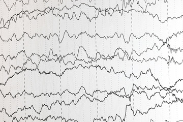 EEG of the pediatric patients, problems in the electrical activity of the brain.Abnormal EEG.