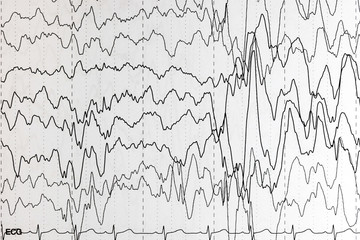 EEG of the pediatric patients, problems in the electrical activity of the brain.Abnormal EEG.