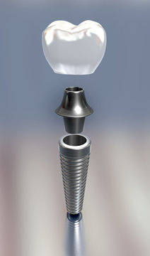 3d illustration of three different parts of a tooth implant