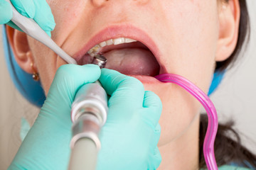 Dental procedure close up