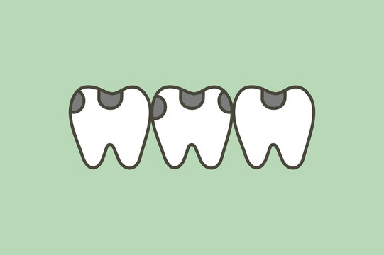 decay tooth or dental caries