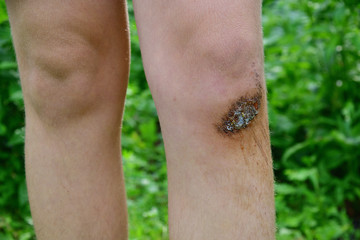 Fototapeta premium Legs of teenager with fresh abrasion on his knee