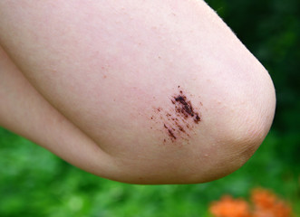 Legs of teenager with fresh abrasion on his elbow