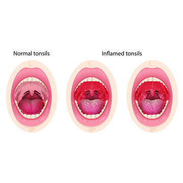 Normal And Inflamed Tonsils