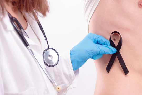Oncological disease concept. Doctor wearing white coat and stethoscope in gloves putting black ribbon as a symbol of melanoma cancer over melanoma on man’s skin.