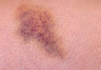 Purple Bruise On Skin