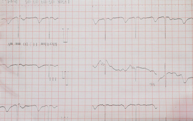 Electrocardiogram of wave in paper report analysis. Medical and healthcare concept.