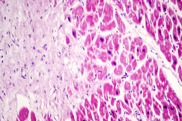 Fototapeta premium Acute myocardial infarction, histology of heart tissue, light micrograph. Area of infarct is paler than than the relatively viable area of heart muscle