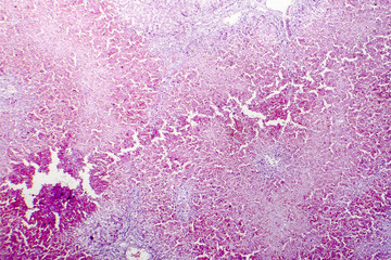 Chronic hepatic congestion, light micrograph, a congestion caused by chronic right heart failure