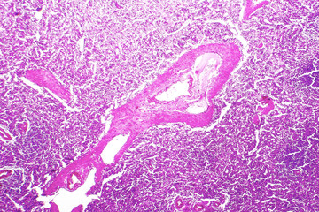 Splenic arterioles hyalinization, light micrograph, hematoxylin and eosin staining - obrazy, fototapety, plakaty