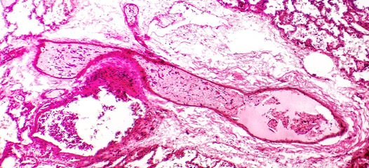 Transparent thrombosis, light micrograph, hematoxylin and eosin staining